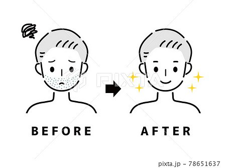 男性　ひげ　ビフォー　アフター 78651637