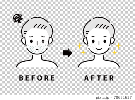 男性　ひげ　ビフォー　アフター 78651637