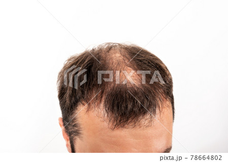 Close-up balding head of a young man on a white isolated background. Close-up balding head of a young man on a white isolated background. 78664802
