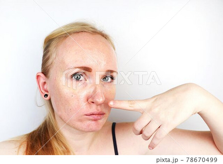 Oily and problem skin. Portrait of a blonde girl with acne, oily skin and pigmentation Oily and problem skin. Portrait of a blonde girl with acne, oily skin and pigmentation 78670499