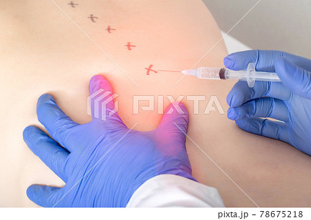 medical spinal block for the treatment of intervertebral disc herniation and protrusion. Concept of a modern treatment for pain relief, blockade therapy 78675218