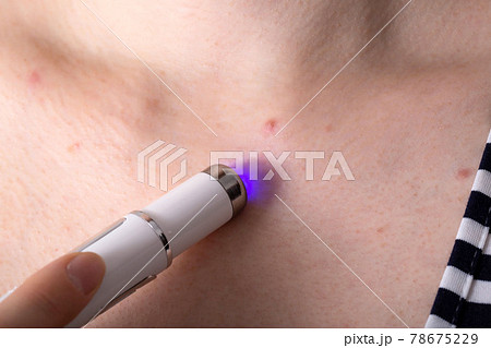 Removing a red pimple on a girl's neck with a cosmetic laser pen, macro 78675229