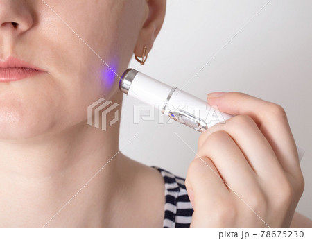 Treatment and removal of inflamed red acne and wrinkles from the cheeks of the girl's face. Modern procedure for laser cleaning of facial skin. Copy space for text Treatment and removal of inflamed red acne and wrinkles from the cheeks of the girl's face. Modern procedure for laser cleaning of facial skin. Copy space for text 78675230