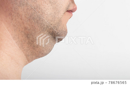 A man has a thick double chin, close-up. Correction and removal of fat from a double chin, plastic surgery. Copy space for text 78676565