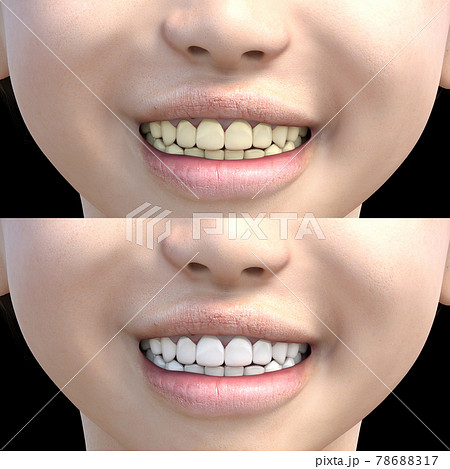 ホワイトニングイメージ 歯の美白 perming3DCGイラスト素材 ホワイトニングイメージ 歯の美白 perming3DCGイラスト素材 78688317