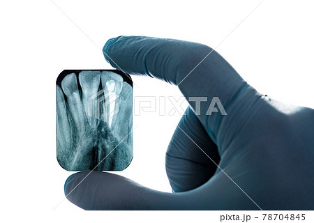 Radiography imaging upper canines root canal hand in glove isolated Radiography imaging upper canines root canal hand in glove isolated 78704845