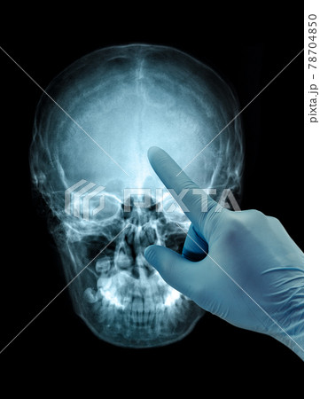 Human skull X-ray front view image film hand in glove Human skull X-ray front view image film hand in glove 78704850