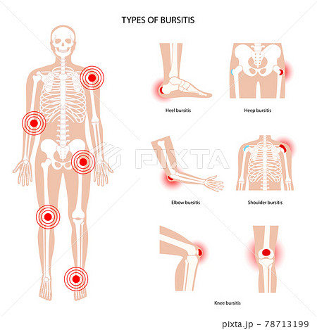 Bursitis icons set 78713199