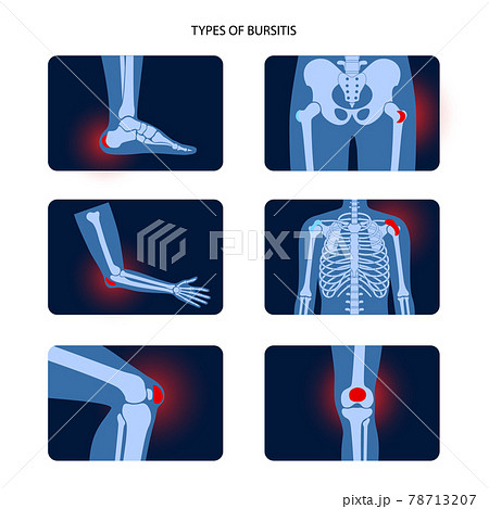 Bursitis icons set 78713207