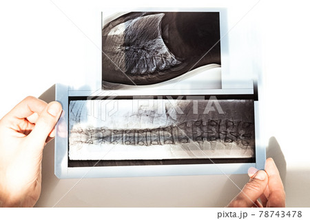 X-ray of the bones of the back of the vertebrae, lungs and chest in case of scoleosis and curvature of the spine. X-ray of the bones of the back of the vertebrae, lungs and chest in case of scoleosis and curvature of the spine. 78743478