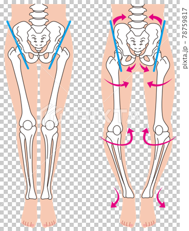 Pelvis and skeleton O-leg skeleton Pelvic distortion Pelvis and skeleton O-leg skeleton Pelvic distortion 78759817
