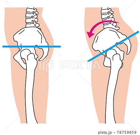 横から見た骨盤 O脚 骨盤の歪みのイラスト素材
