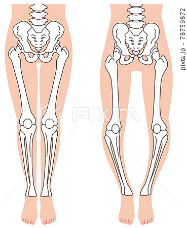 骨盤と骨格 O脚の骨格 骨盤の歪みのイラスト素材