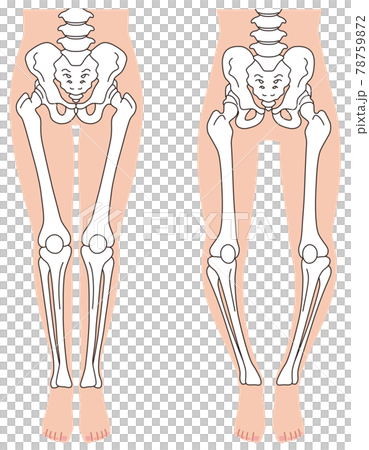 骨盆和骨架 O 型腿骨架 骨盆扭曲 78759872