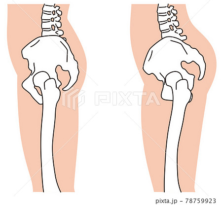横から見た骨盤 O脚 骨盤の歪みのイラスト素材
