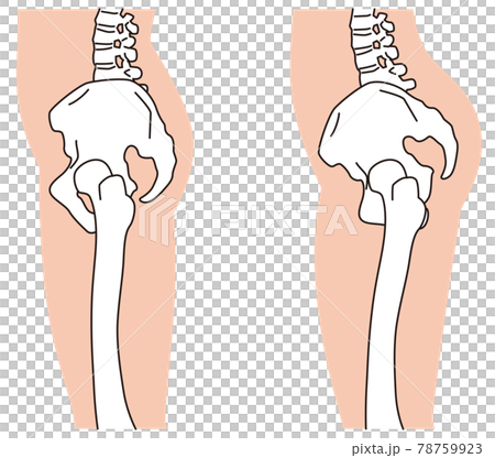 横から見た骨盤 O脚 骨盤の歪みのイラスト素材