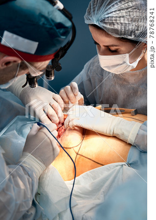 A team of male and female surgeons operate on breast cancer, mammoplasty with plastic reconstruction, close-up, modern methods of fighting oncology A team of male and female surgeons operate on breast cancer, mammoplasty with plastic reconstruction, close-up, modern methods of fighting oncology 78768241