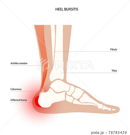 Bursitis inflammation concept Bursitis inflammation concept 78783429
