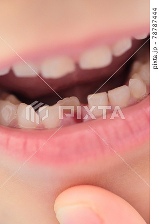 乳歯から永久歯への生え変わりの写真素材