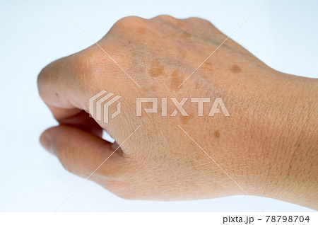 手の甲のシミに悩む女性の右手 78798704