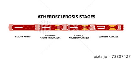 Atherosclerosis stages. Healthy artery, beginning cholesterol plaque, advanced cholesterol plaque, complete blockage. 78807427