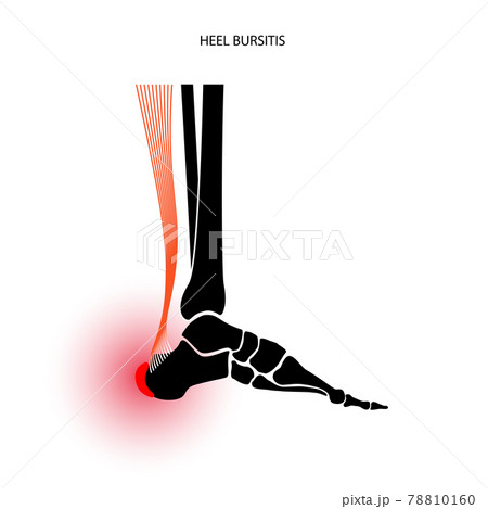 Bursitis inflammation concept Bursitis inflammation concept 78810160