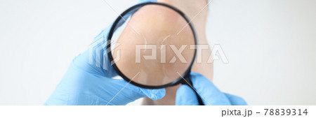 Doctor in protective gloves examining patients heels using magnifying glass closeup Doctor in protective gloves examining patients heels using magnifying glass closeup 78839314