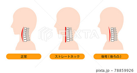 ストレートネック・頸椎後湾症・正常な首の骨のイメージ 78859926