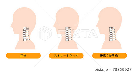 ストレートネック・頸椎後湾症・正常な首の骨のイメージ 78859927