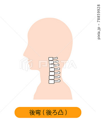 頸椎後湾症の首の骨のイメージ 78859928