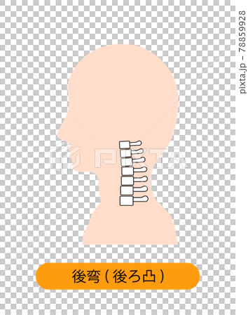 頸椎後湾症の首の骨のイメージ 78859928