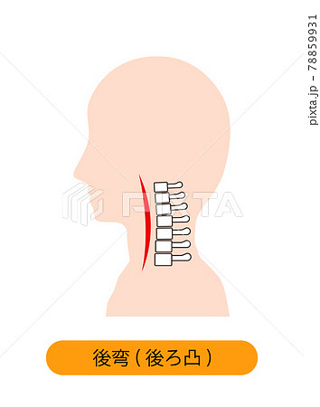 頸椎後湾症の首の骨のイメージのイラスト素材