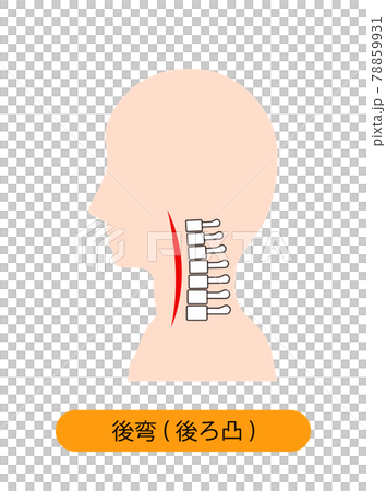 頸椎後湾症の首の骨のイメージ 78859931