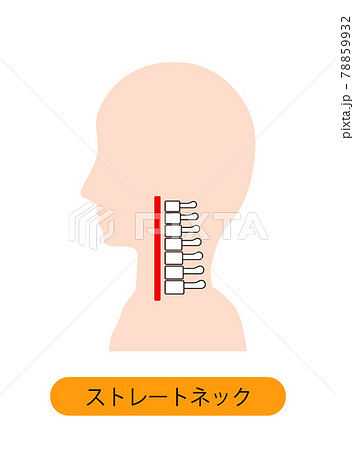 ストレートネック（スマホ首）　骨のイメージ 78859932