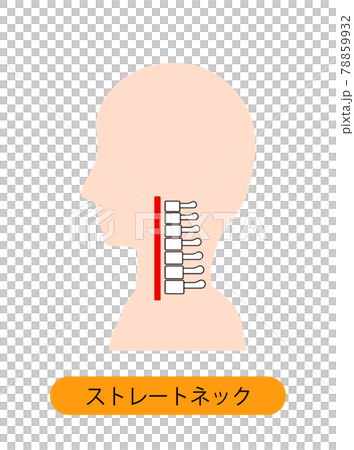 ストレートネック（スマホ首）　骨のイメージ 78859932