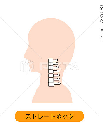 ストレートネック（スマホ首）　骨のイメージ 78859933