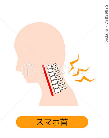 ストレートネック（スマホ首）　骨のイメージ 78859935