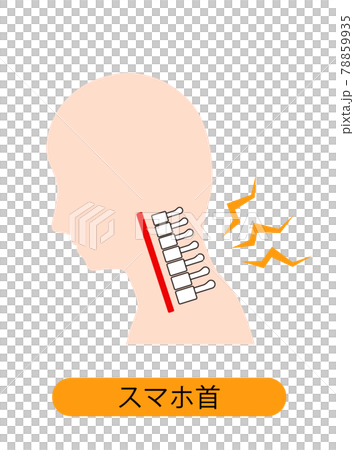 ストレートネック（スマホ首）　骨のイメージ 78859935