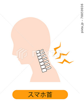 ストレートネック（スマホ首）　骨のイメージ 78859936