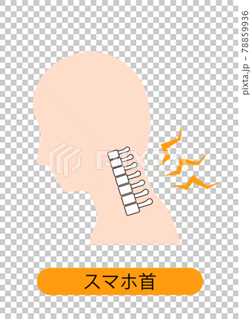 ストレートネック（スマホ首）　骨のイメージ 78859936