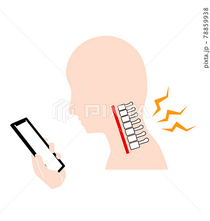 ストレートネック（スマホ首）　骨のイメージ 78859938