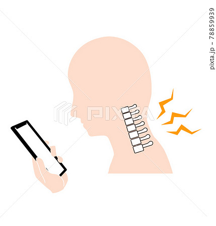 ストレートネック（スマホ首）　骨のイメージ 78859939