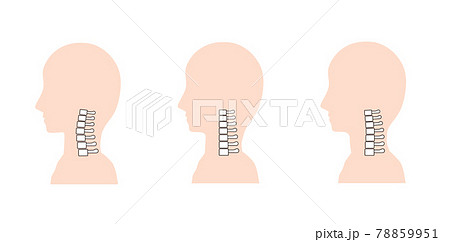 ストレートネック・頸椎後湾症・正常な首の骨のイメージ 78859951