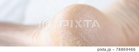 Leg with scaly and cracked heels closeup Leg with scaly and cracked heels closeup 78869466