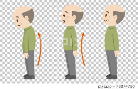 Before and after of a senior man with a bent back 78874780