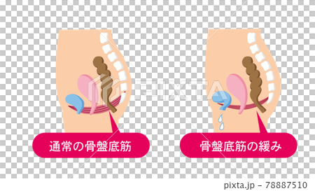 Mechanism of urine leakage Medical illustration of pelvic floor muscles Mechanism of urine leakage Medical illustration of pelvic floor muscles 78887510