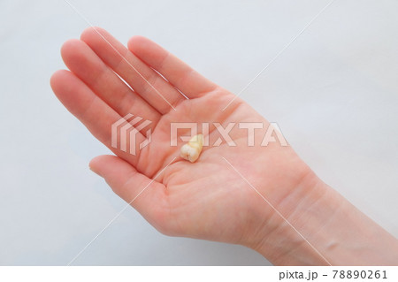 親知らずの抜歯 親知らずの抜歯 78890261