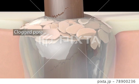 Acne And Pimples, Stages Of Development, anatomy medical illustration 78900236
