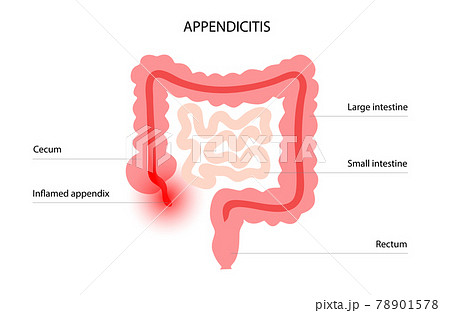 Appendicitis là gì? Nguyên nhân, triệu chứng và phương pháp điều trị hiệu quả