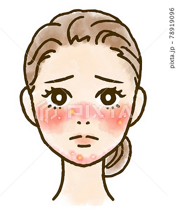 マスクによる肌荒れとニキビに悩む女性の顔イラストのイラスト素材